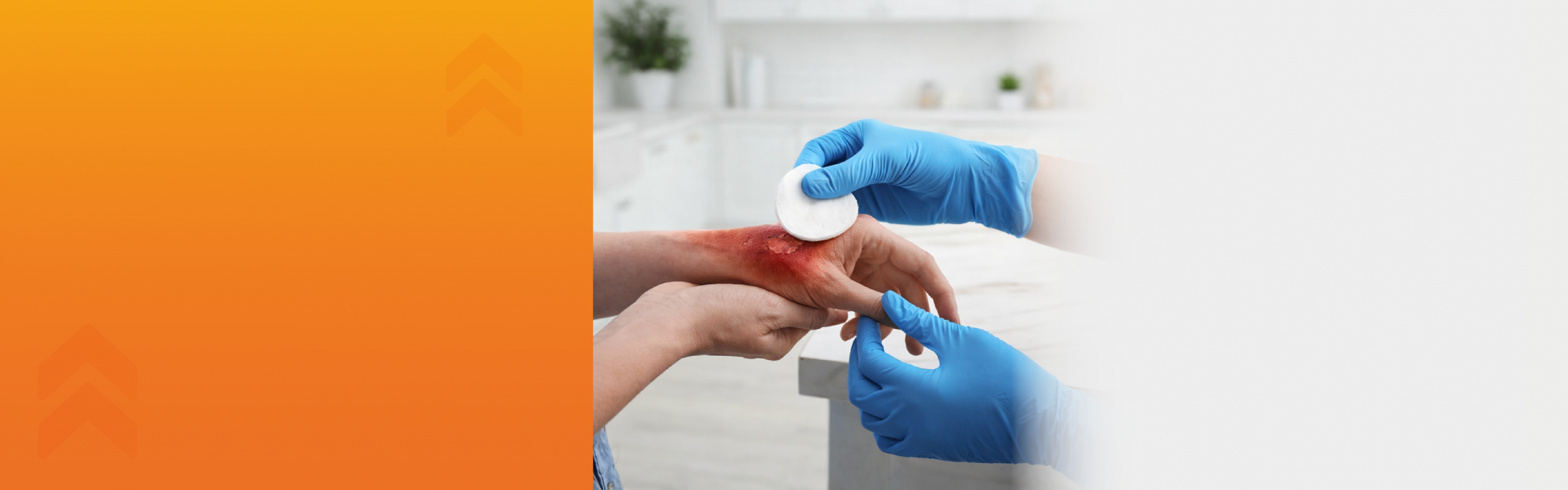 TRATAMIENTO A PACIENTES CON QUEMADURAS